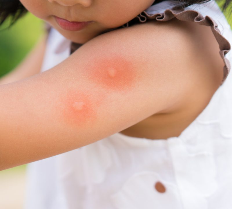 mosquito bites on a little girls arm